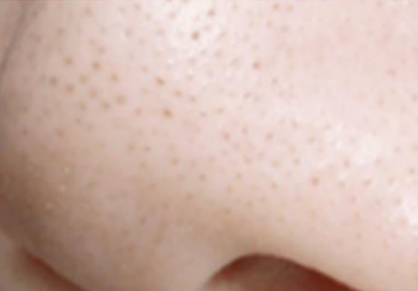 角栓・毛穴汚れが多い肌